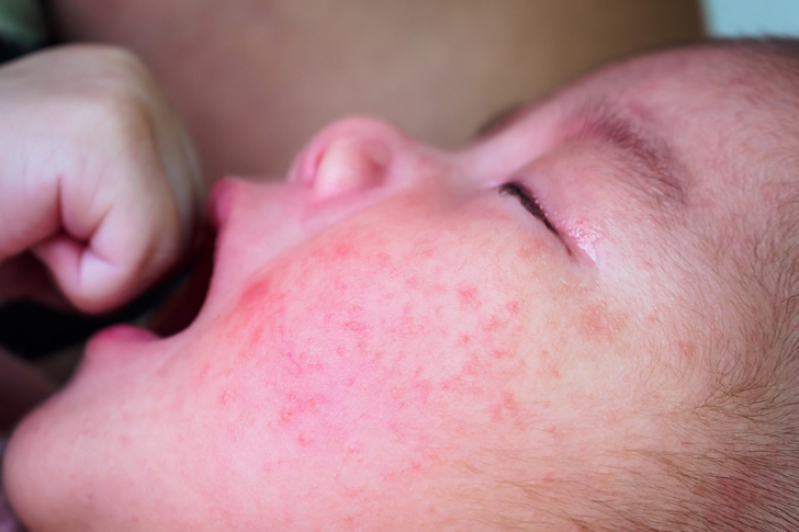 子どもの繰り返す乾燥性湿疹には保湿ケアが重要 ワセリンは効果無し Nukumoly